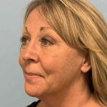 Fat Injections Before & After Patient #11305
