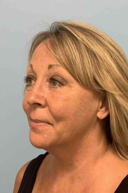 Fat Injections Before & After Patient #11305