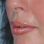 Fat Injections Before & After Patient #11326