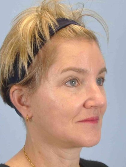 Fat Injections Before & After Patient #11354