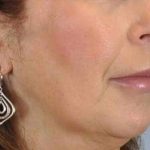 Fat Injections Before & After Patient #11357
