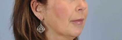 Fat Injections Before & After Patient #11357