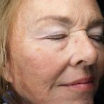 Facelift Before & After Patient #11410