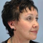Facelift Before & After Patient #11431