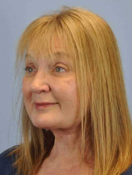 Facelift Before & After Patient #11436
