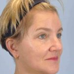 Facelift Before & After Patient #11457