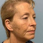 Eyelid Surgery Before & After Patient #11476