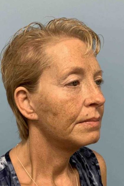 Eyelid Surgery Before & After Patient #11476
