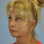 Eyelid Surgery Before & After Patient #11490
