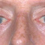 Eyelid Surgery Before & After Patient #11497