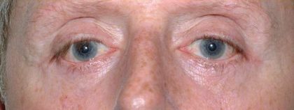 Eyelid Surgery Before & After Patient #11497