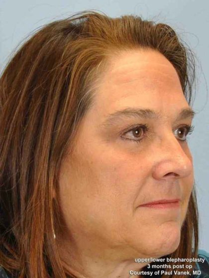 Eyelid Surgery Before & After Patient #11504