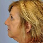 Eyelid Surgery Before & After Patient #11511