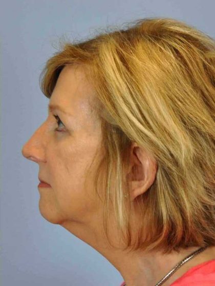 Eyelid Surgery Before & After Patient #11511