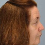 Eyelid Surgery Before & After Patient #11518