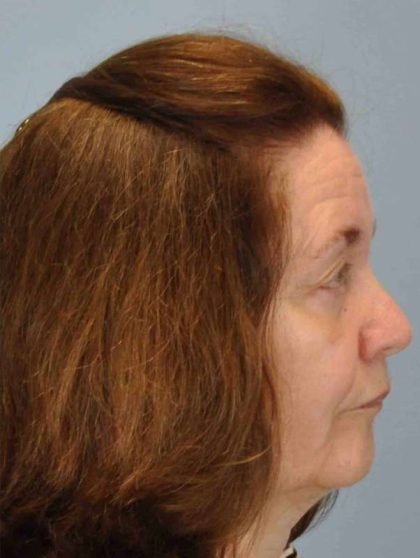Eyelid Surgery Before & After Patient #11518
