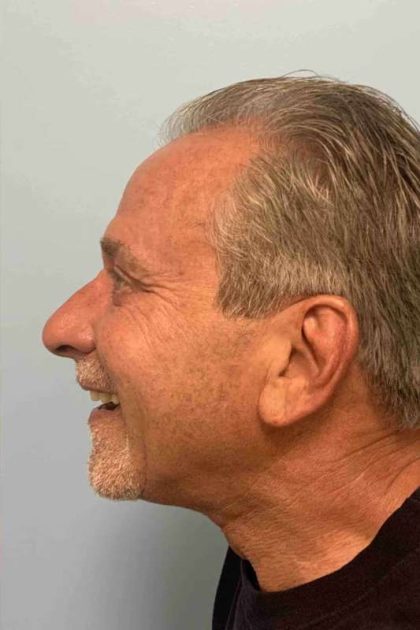 Eyelid Surgery Before & After Patient #11525