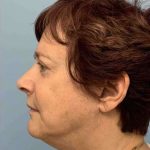 Eyelid Surgery Before & After Patient #11532
