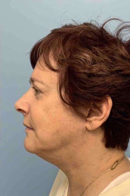 Eyelid Surgery Before & After Patient #11532