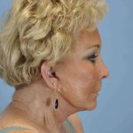 Eyelid Surgery Before & After Patient #11539
