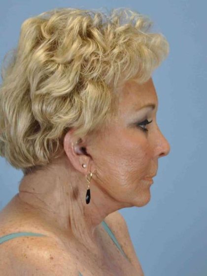 Eyelid Surgery Before & After Patient #11539