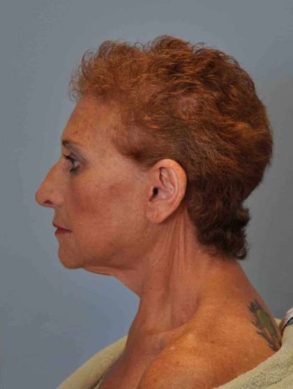 Eyelid Surgery Before & After Patient #11558