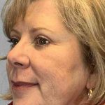 Eyelid Surgery Before & After Patient #11593