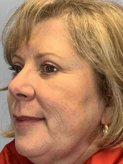 Eyelid Surgery Before & After Patient #11593