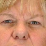 Eyelid Surgery Before & After Patient #11596