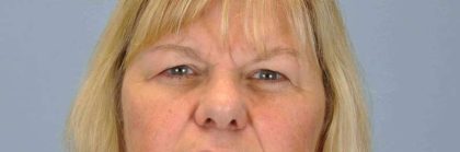 Eyelid Surgery Before & After Patient #11596