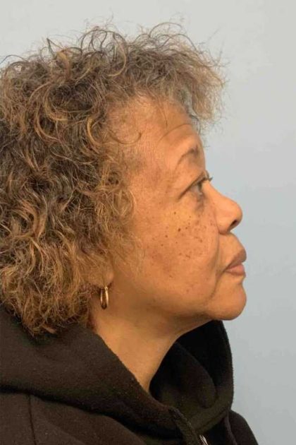 Eyelid Surgery Before & After Patient #11603