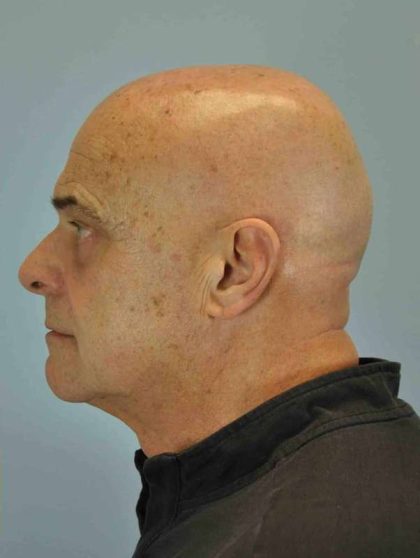 Eyelid Surgery Before & After Patient #11610