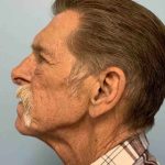 Eyelid Surgery Before & After Patient #11631