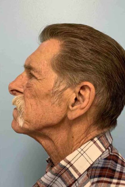 Eyelid Surgery Before & After Patient #11631