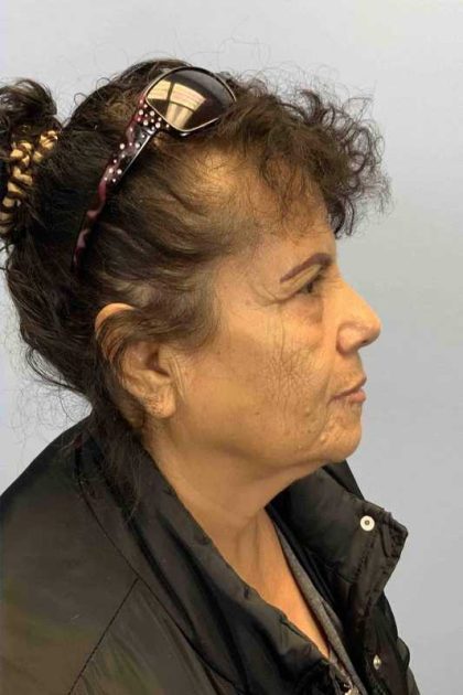 Eyelid Surgery Before & After Patient #11643