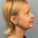 Eyelid Surgery Before & After Patient #11668