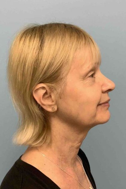 Eyelid Surgery Before & After Patient #11668