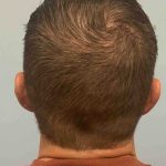Ear Surgery Before & After Patient #11673