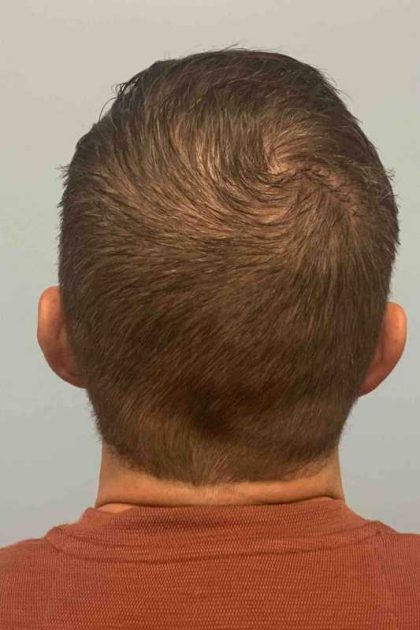 Ear Surgery Before & After Patient #11673