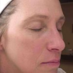 Chemical Peels Before & After Patient #11701