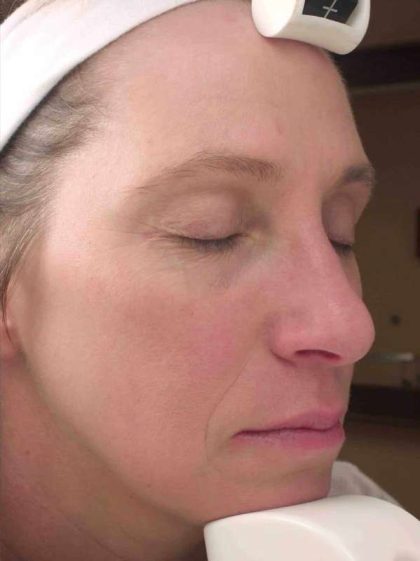 Chemical Peels Before & After Patient #11701