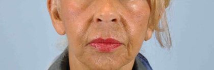Chemical Peels Before & After Patient #11704