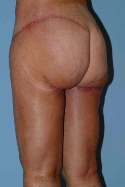Buttocks Before & After Patient #11711