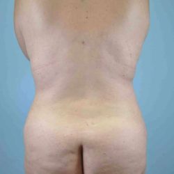 Buttocks Before & After Patient #11721
