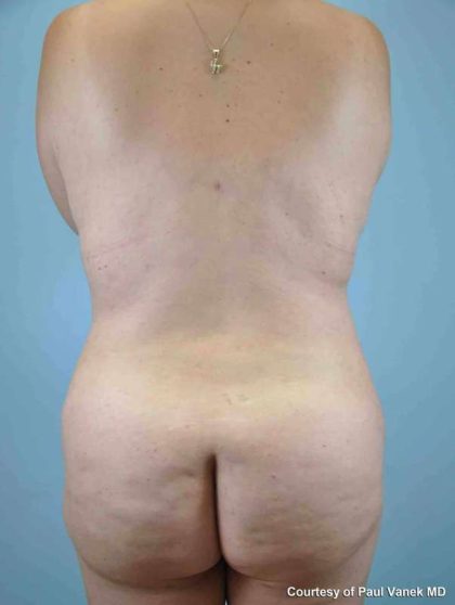 Buttocks Before & After Patient #11721