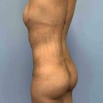 Buttocks Before & After Patient #11728
