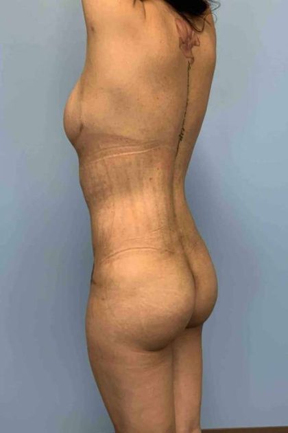 Buttocks Before & After Patient #11728
