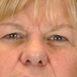 Brow Lift Before & After Patient #11801