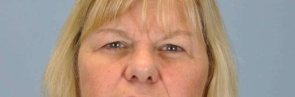 Brow Lift Before & After Patient #11801