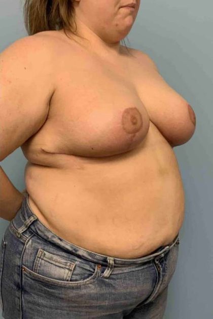 Breast Reduction Before & After Patient #11854